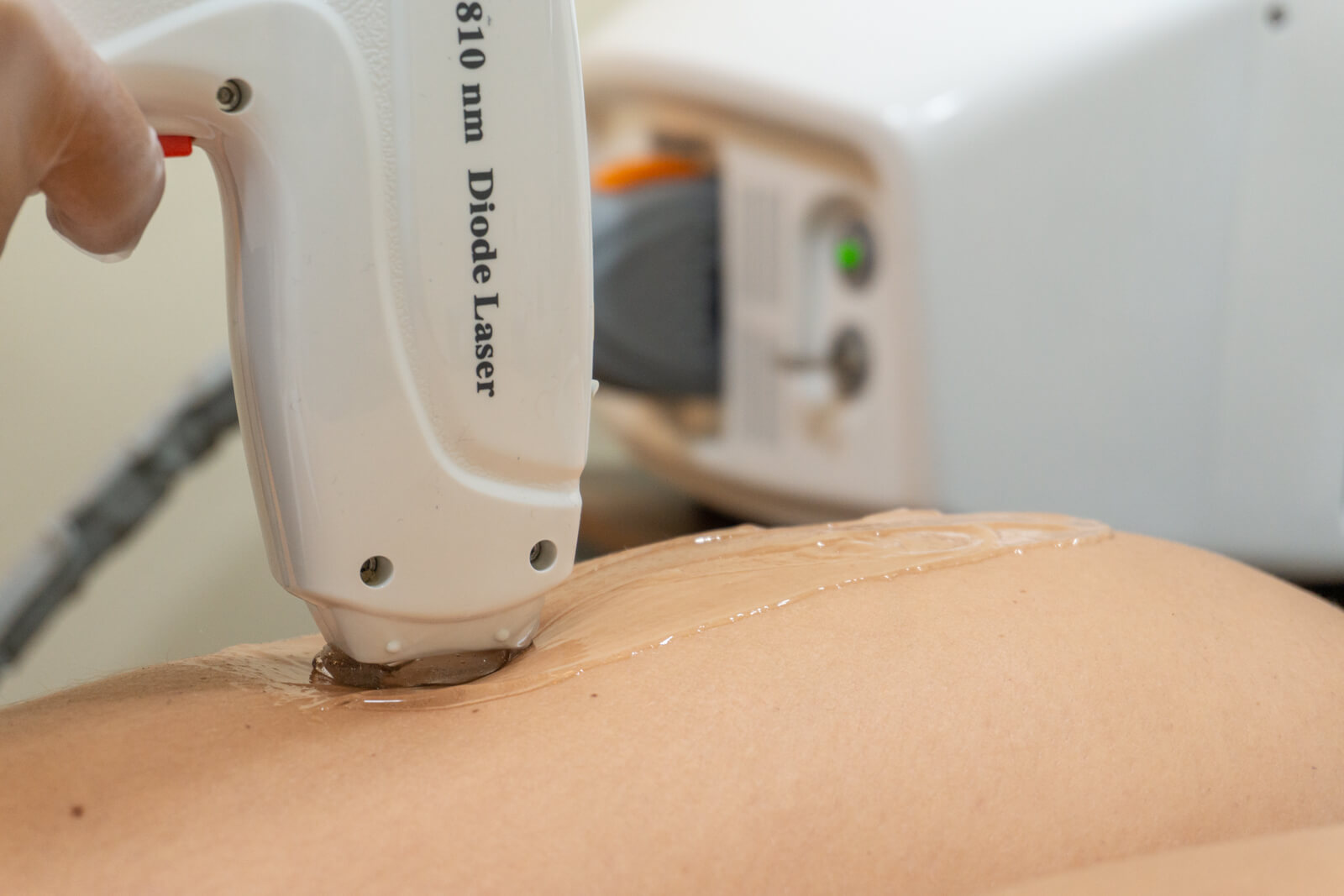 depilacion laser diodo zaragoza