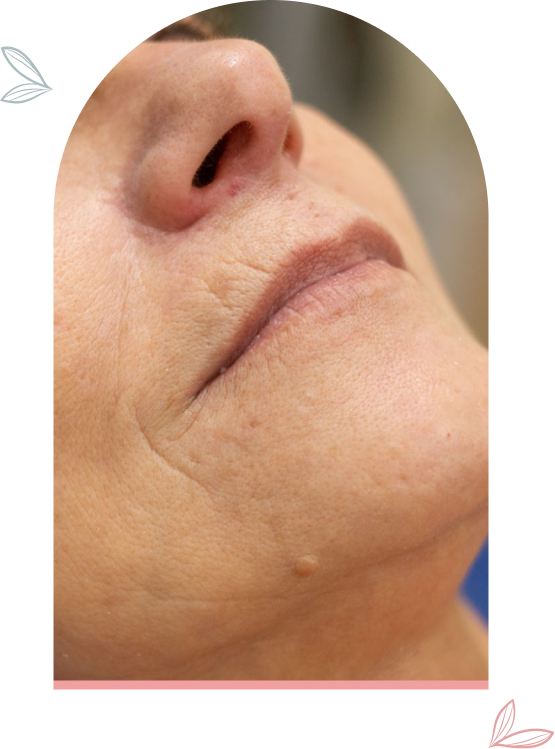 Tratamiento Rejuvenecimiento facial